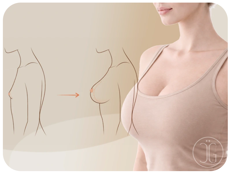 Ilustración de aumento mamario - Ganssthetic