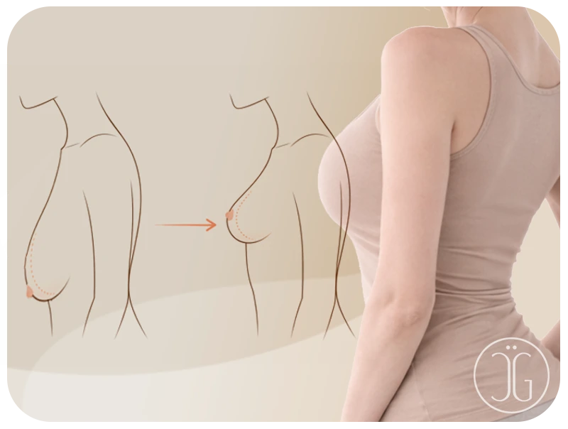 Ilustración de mastopexia - Ganssthetic