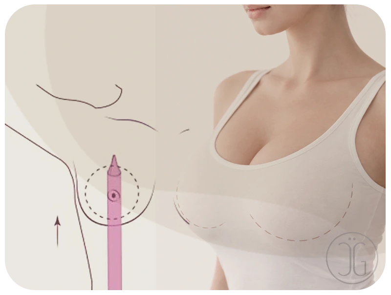 Ilustración de técnica Preservé - Ganssthetic