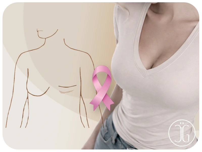 Ilustración de reconstrucción mamaria - Ganssthetic