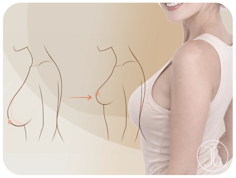 Ilustración de reducción mamaria - Ganssthetic